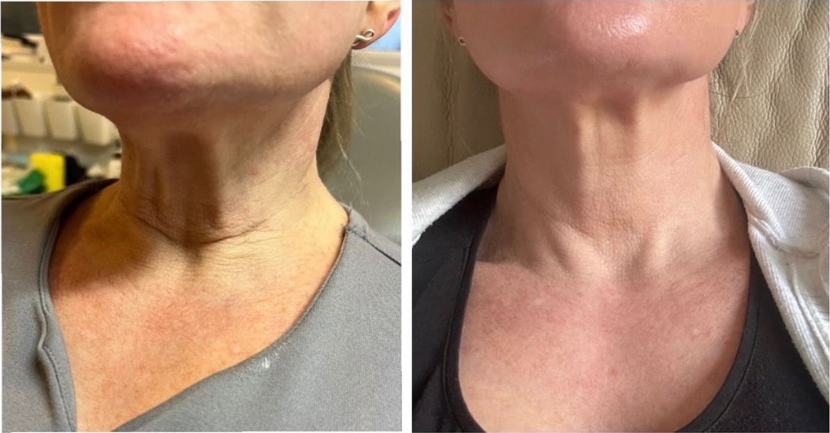 Before and after photos of a client's neck, side by side