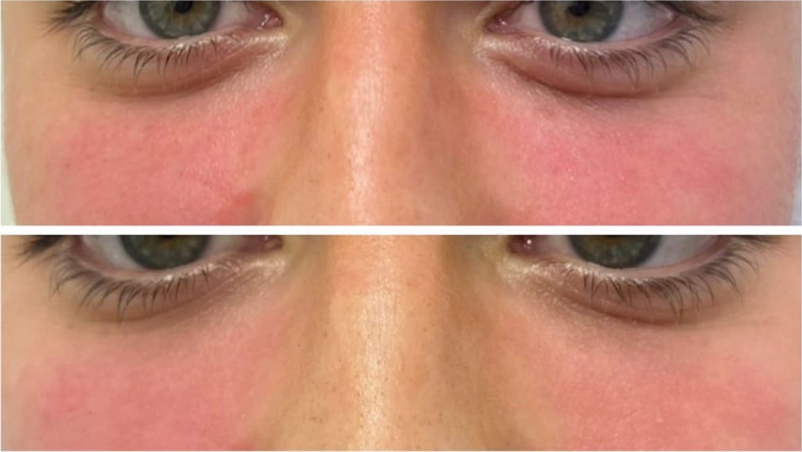 Before and after photos of a client's under-eye area, one above the other