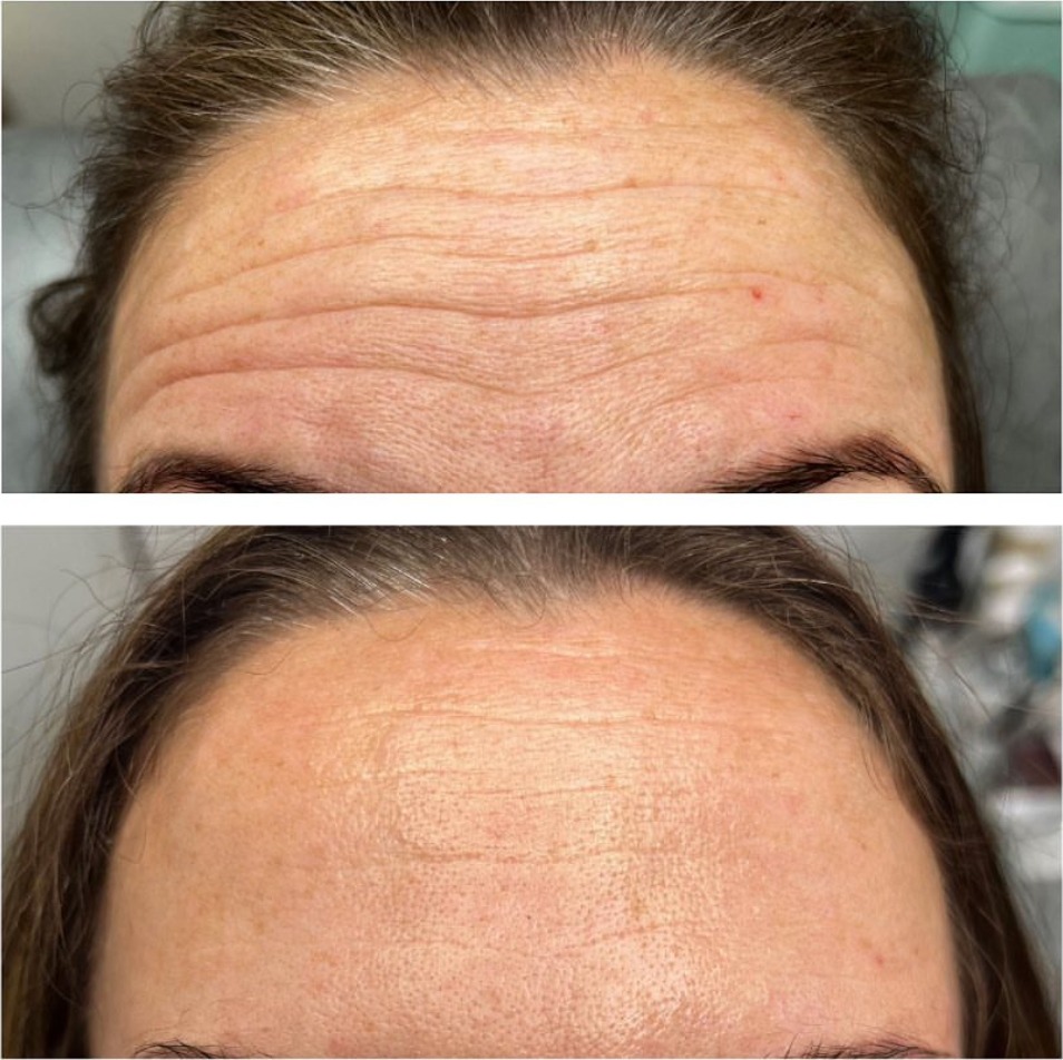 Before and after photos of a client's forehead, one above the other