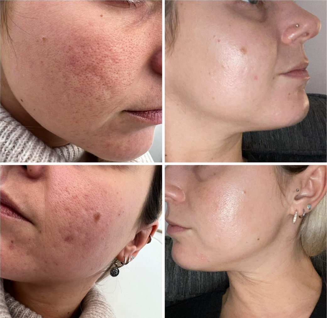 Before and after photos of a client's cheek skin, in a grid of four