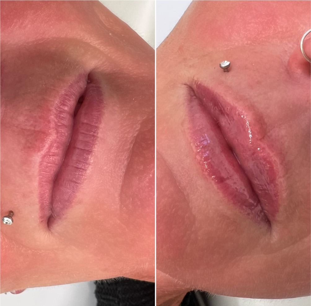 Before and after photos of a client's lips, side by side