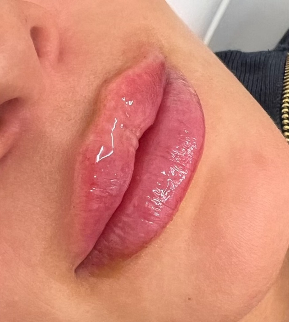 Close-up of a client's lips after a lip treatment