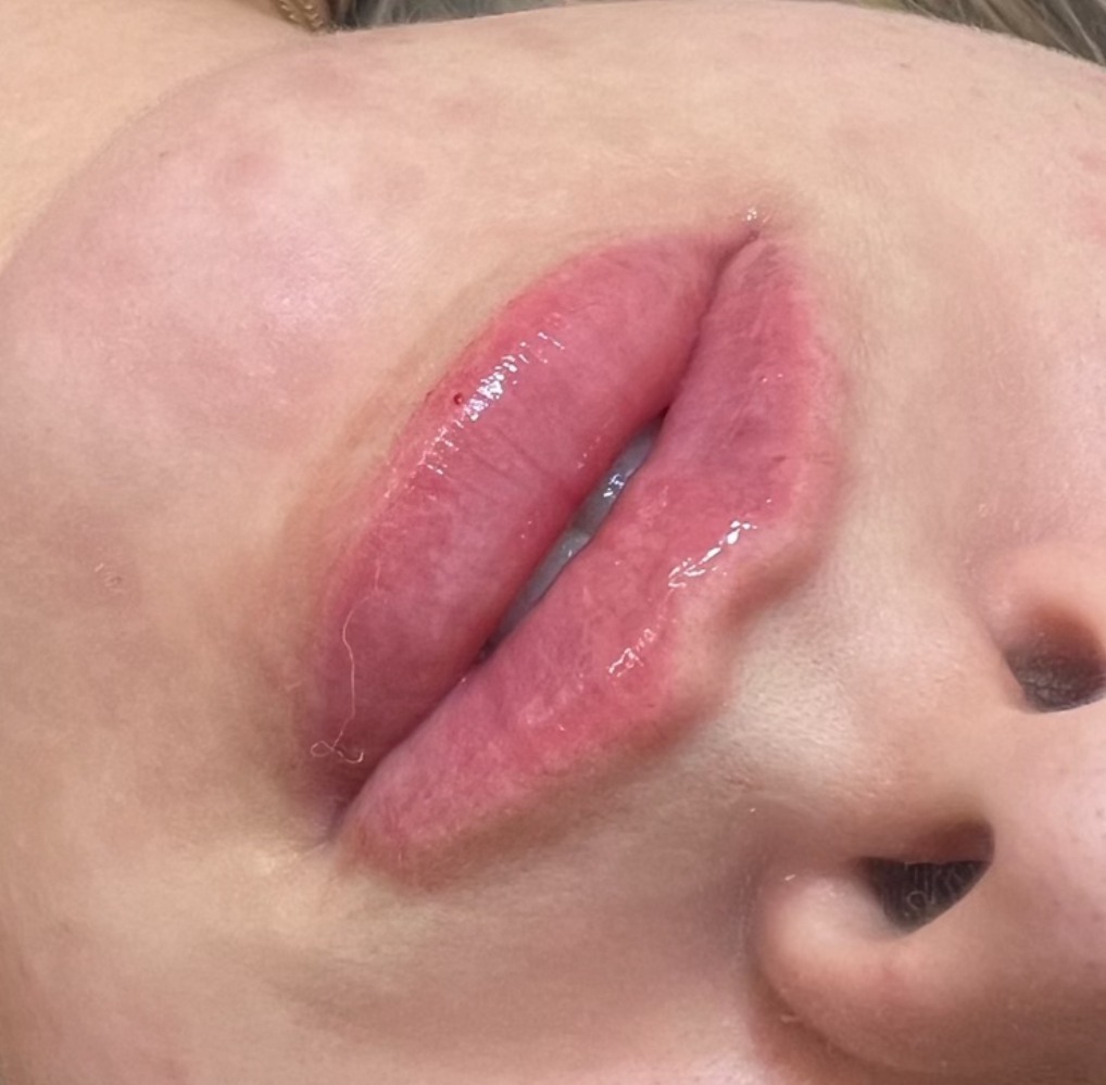 Close-up of a client's lips after treatment